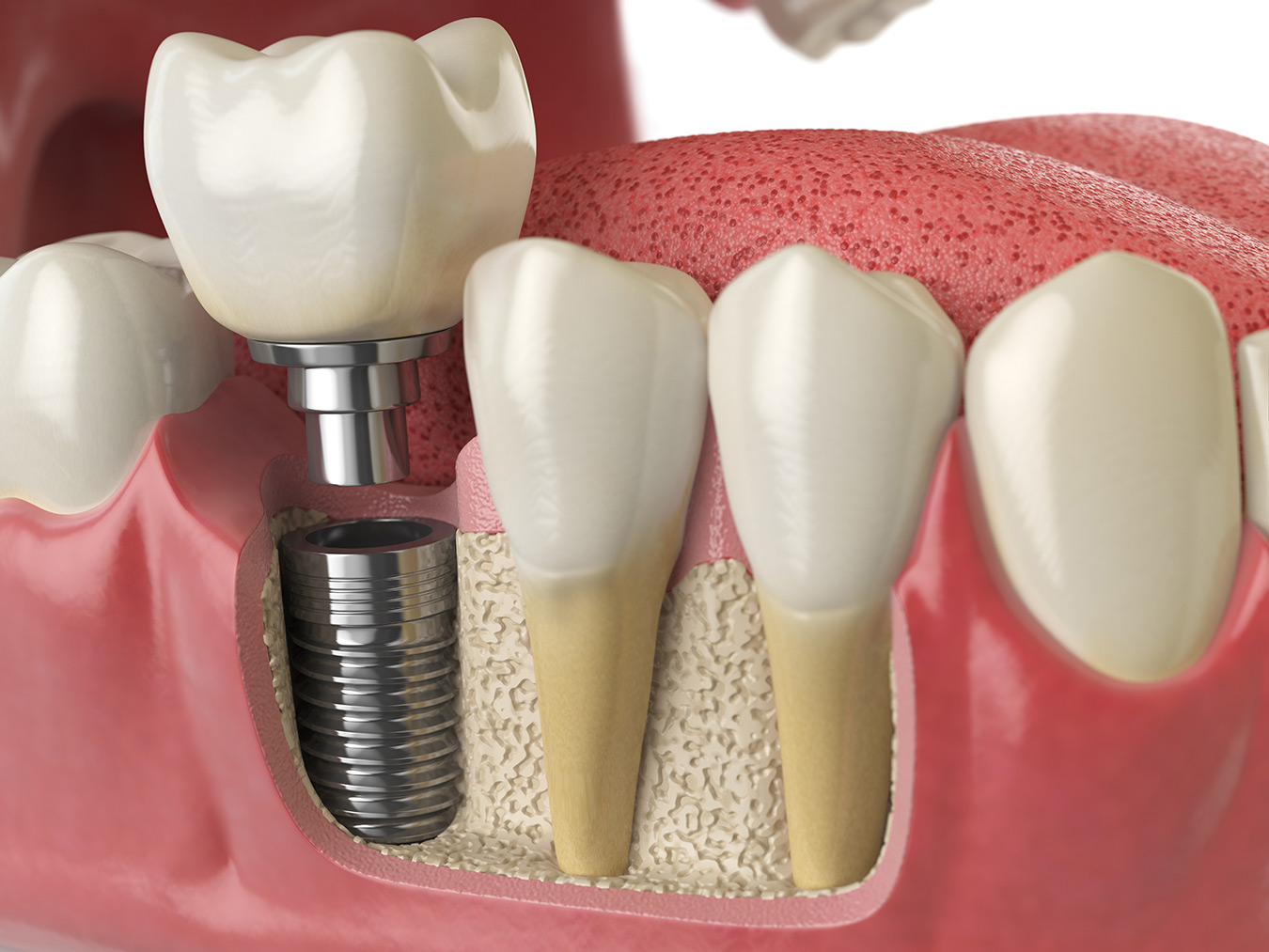 implantologie-dentara